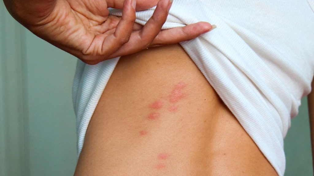 Ani komár, ani osa: toto je najbolestivejšie uhryznutie zvieraťa v lete a takto ho môžete rozpoznať