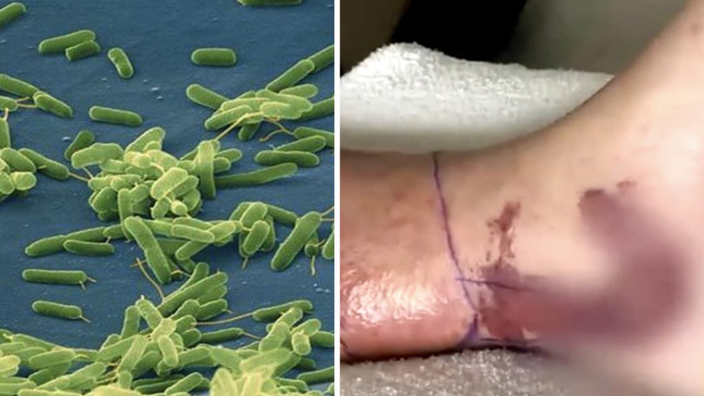 Európa venuje pozornosť geografickému rozšíreniu „mäsožravých“ baktérií v súvislosti s nárastom počtu ochorení v Baltskom mori