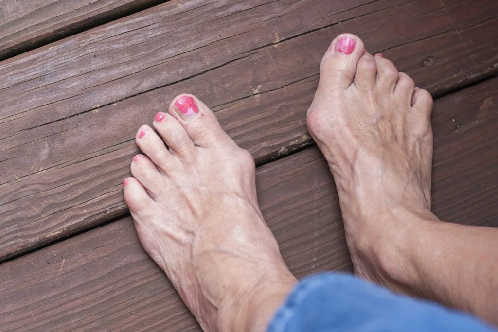 10 faktov o bolesti nôh: „Ľudia často myslia, že majú mozole, ale pri liečbe sa rozširujú.“