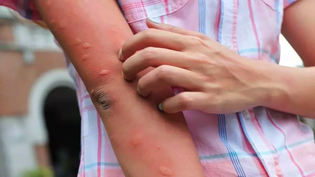 Ani komár, ani osa: najstrašnejšie uhryznutie zvieraťa tohto leta. Ako ho rozpoznať?