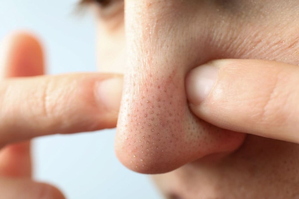 Mnohí považujú malé bodky na nose za čierne bodky – odborník vysvetľuje, čo to v skutočnosti je
