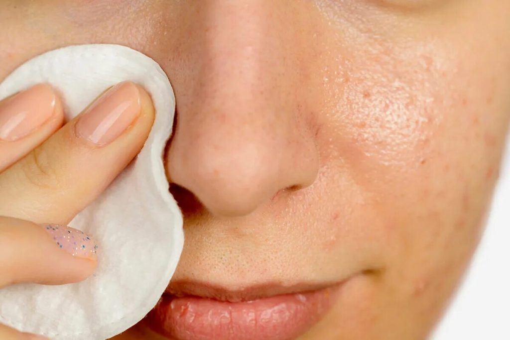 Mnohí považujú malé bodky na nose za čierne bodky – odborník vysvetľuje, čo to v skutočnosti je