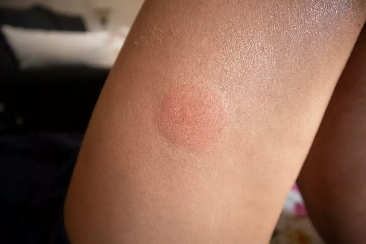 Ani komár, ani osa: najstrašnejšie uhryznutie zvieraťa tohto leta. Ako ho rozpoznať?