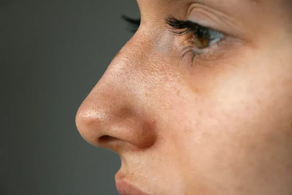 Mnohí považujú malé bodky na nose za čierne bodky – odborník vysvetľuje, čo to v skutočnosti je