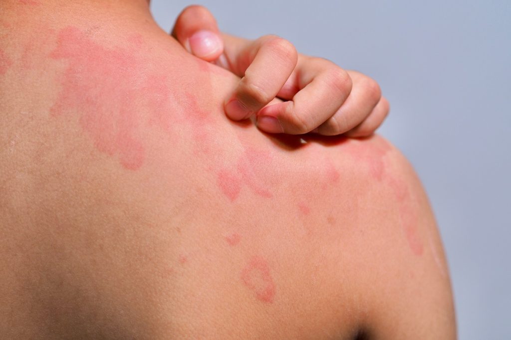 Kliešť, ploštica alebo komár: ako zistiť, ktoré hmyzie vás poštípalo