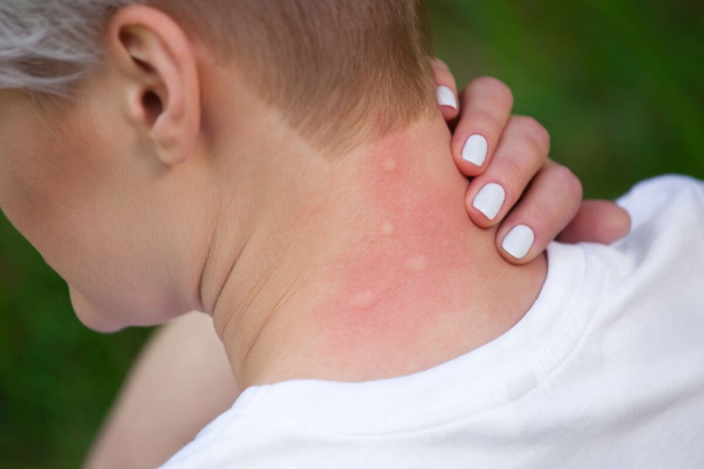 Kliešť, ploštica alebo komár: ako zistiť, ktoré hmyzie vás poštípalo